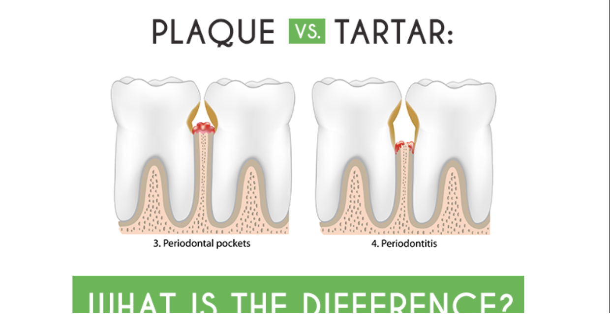 Plaque VS Tartarv
