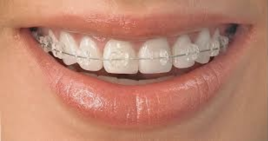 braces