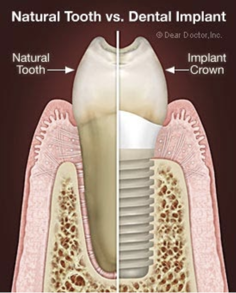 natural tooth vs dental implant