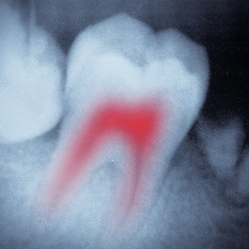 tooth xray