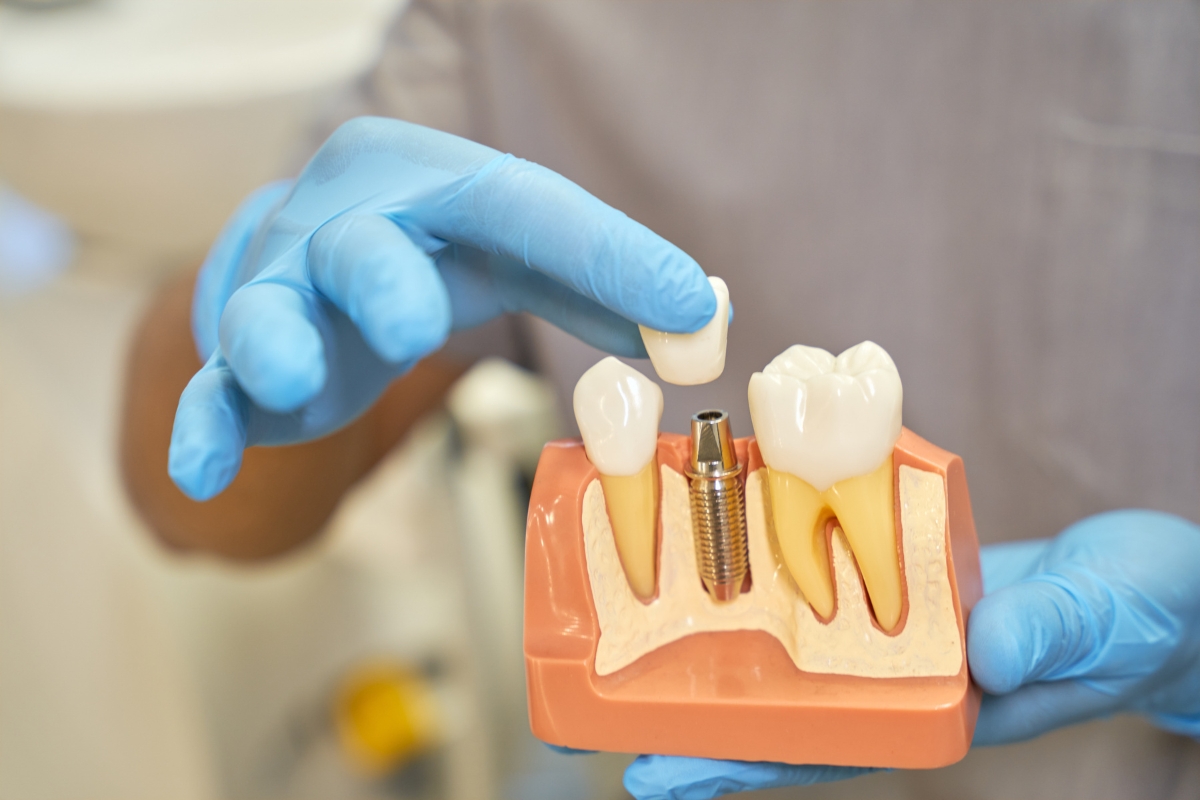Dental implants in Waldorf
