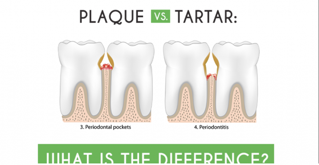 Differentiating Between Plaque and Tartar