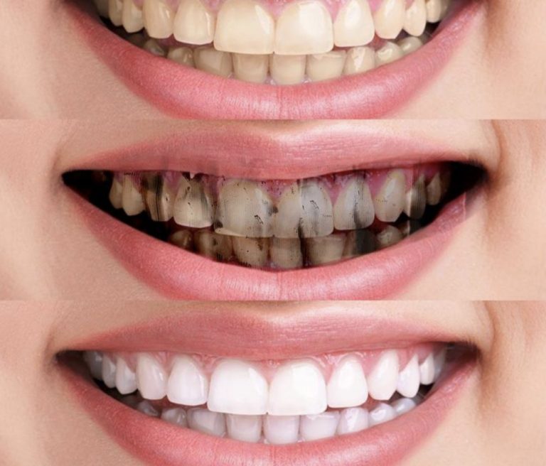 Best Charcoal Toothpaste For Whitening