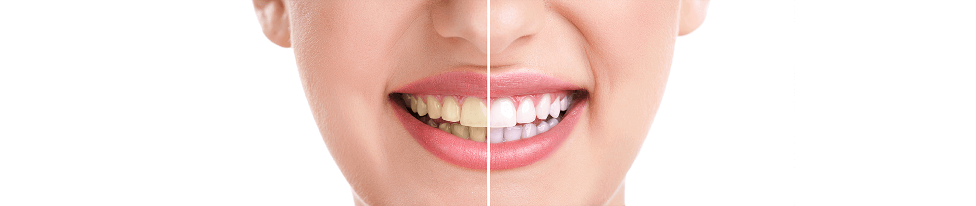 Teeth Whitening in Waldorf, Maryland