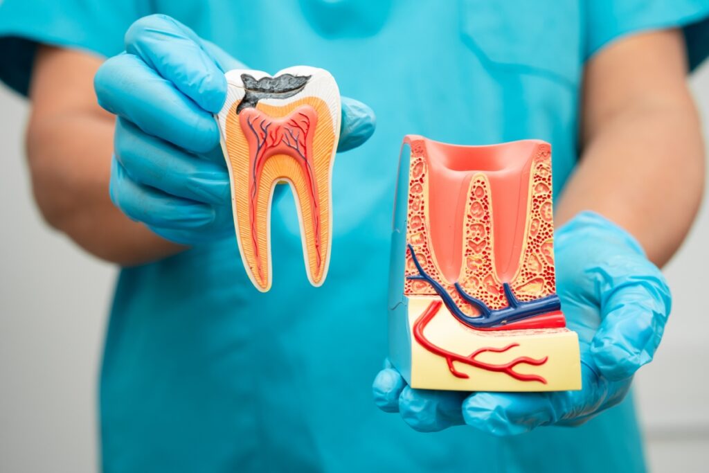 root canal failure